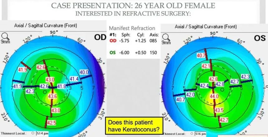 Genetic-testing-may-be-the-key-to-identifying-keratoconus-suspects-ophthalmology-retina